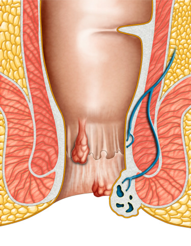 CRH O'Regan System: NonSurgical Hemorrhoid Banding Treatment